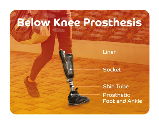 How Below Knee Prosthesis Can Help with Common Amputees