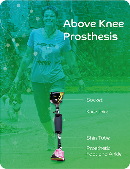 Above Knee Prosthesis Diagram